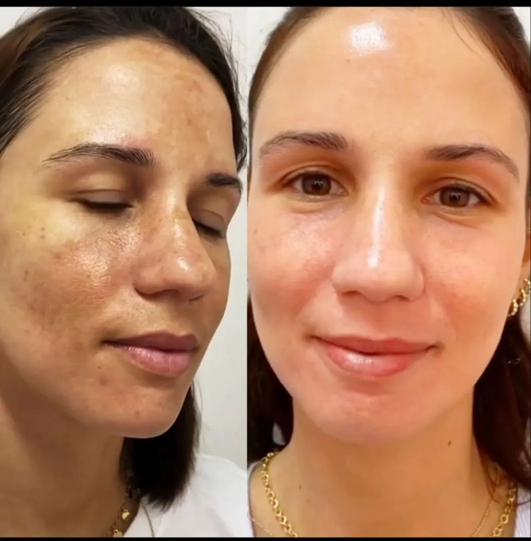 Hyperpigmentation Treatment treatment at Kira Exotica, a beauty salon in Indore
